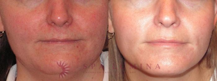 Before & After Photodynamic Therapy Case 49 Front View in Barrie, Ontario