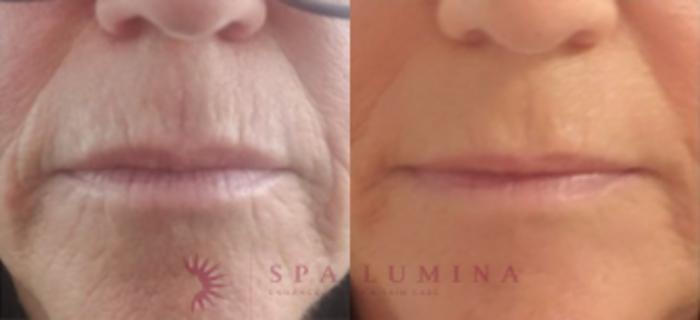 Before & After Plasma Skin Resurfacing Case 27 Front View in Barrie, Ontario