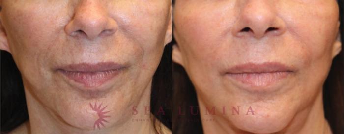 Before & After Plasma Skin Resurfacing Case 28 Front View in Barrie, Ontario