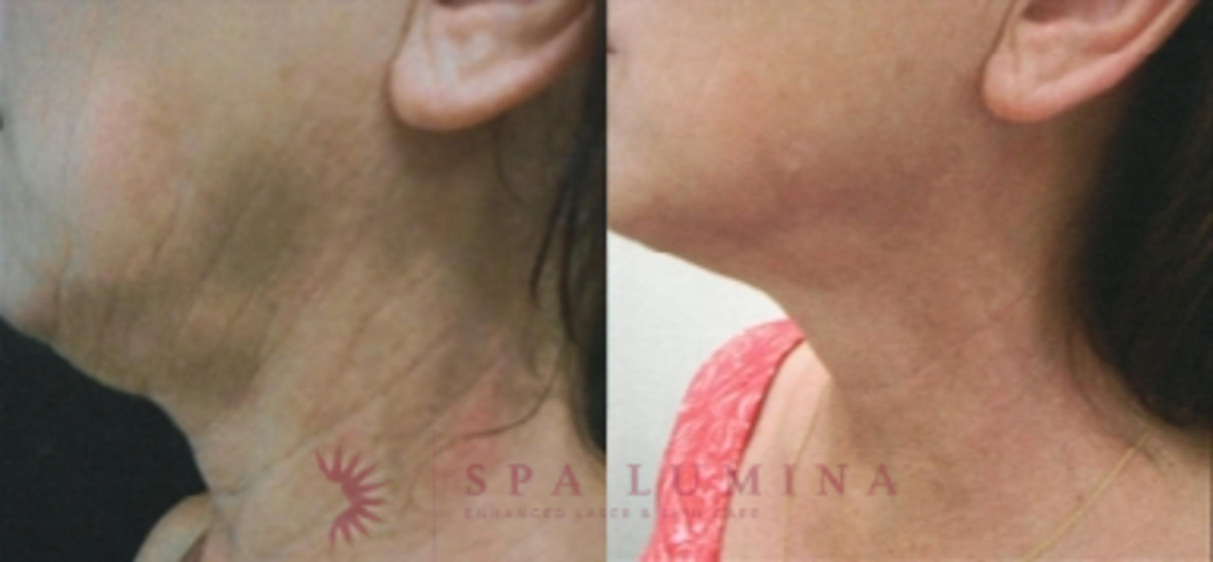 Before & After Plasma Skin Resurfacing Case 29 Left Side View in Barrie, Ontario