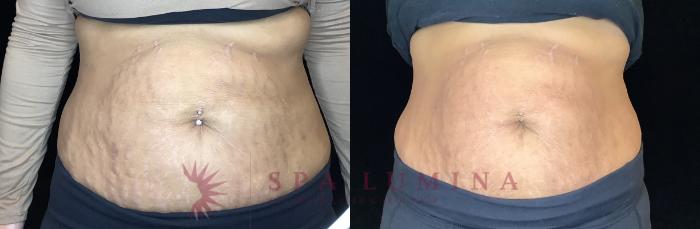 Before & After Plasma Skin Resurfacing Case 90 Front View in Barrie, Ontario