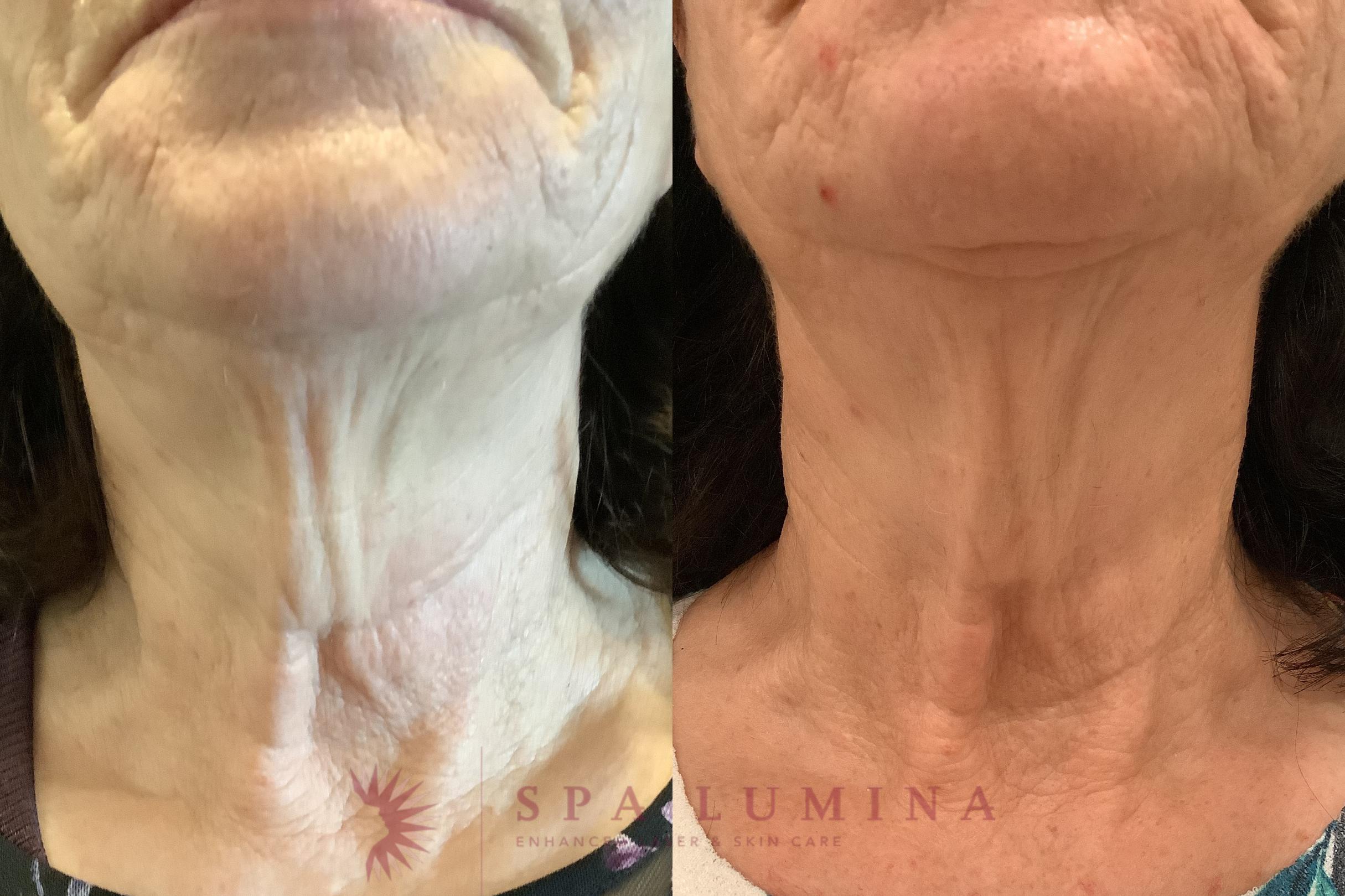 Before & After Plasma Skin Resurfacing Case 91 Front View in Barrie, Ontario