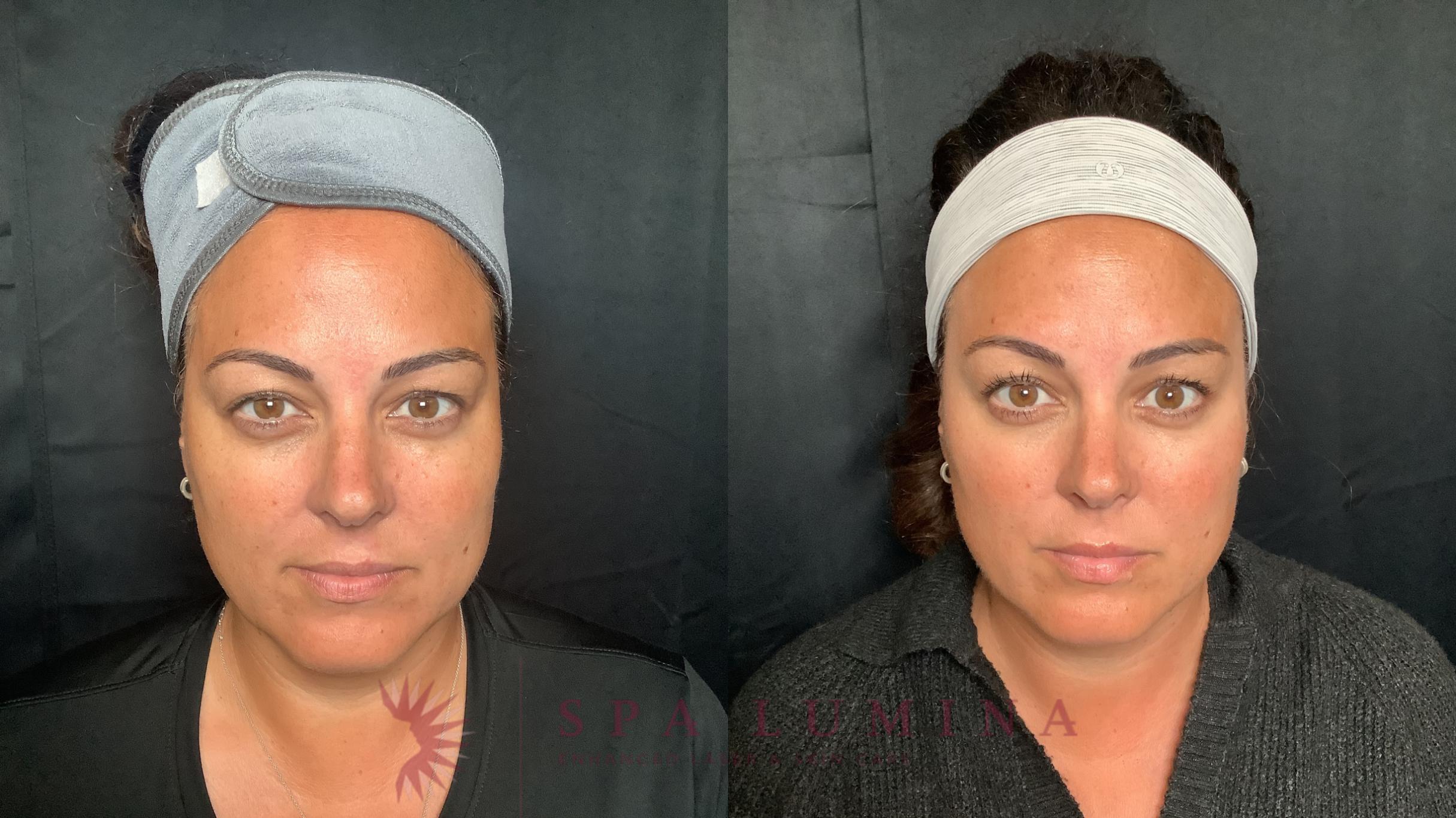 Before & After Plasma Skin Resurfacing Case 94 Front View in Barrie, Ontario