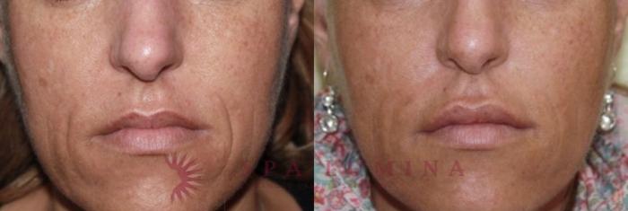 Before & After Secret RF Microneedling Case 32 Front View in Barrie, Ontario