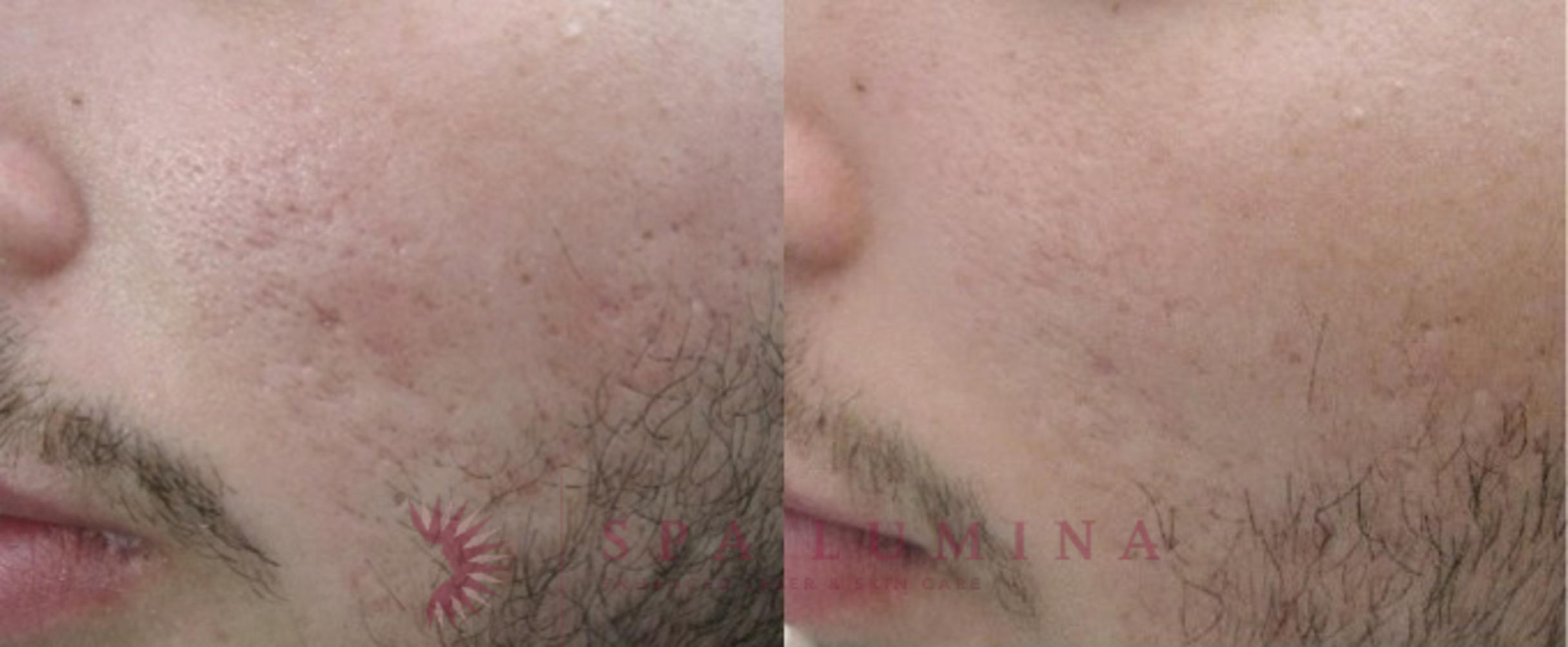 Before & After Secret RF Microneedling Case 33 Left Oblique View in Barrie, Ontario