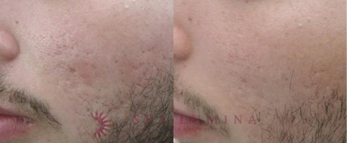 Before & After Secret RF Microneedling Case 33 Left Oblique View in Barrie, Ontario