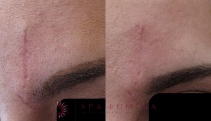 Before & After Secret RF Microneedling Case 34 Front View in Barrie, Ontario