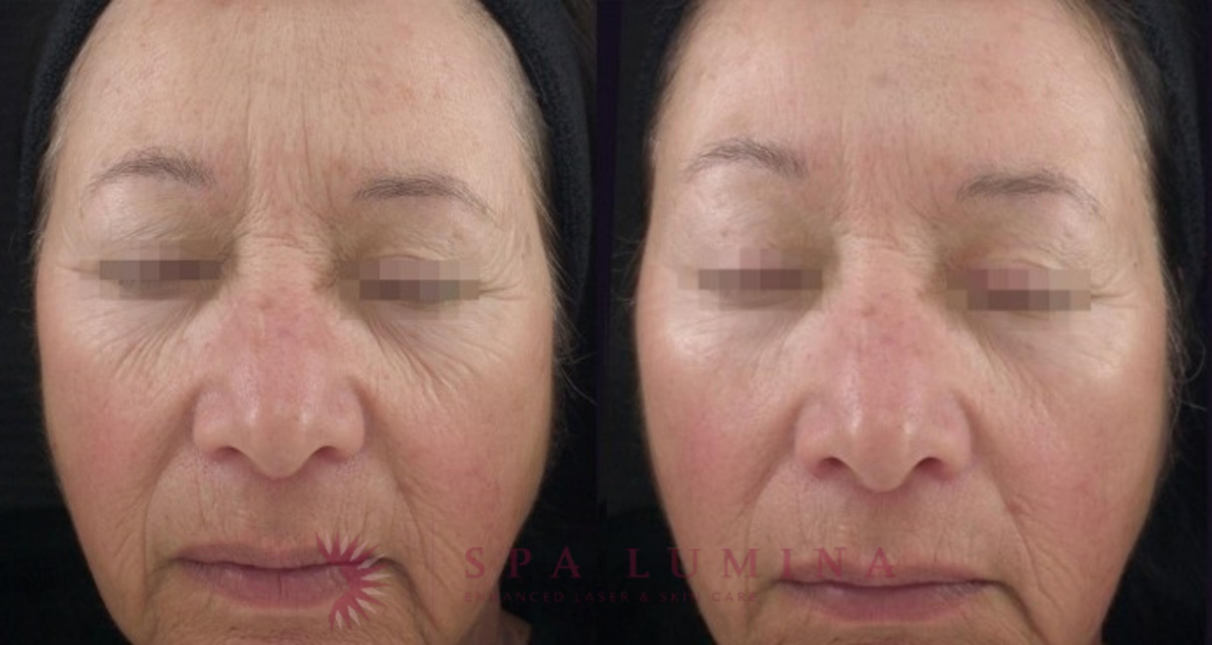 Before & After Secret RF Microneedling Case 35 Front View in Barrie, Ontario