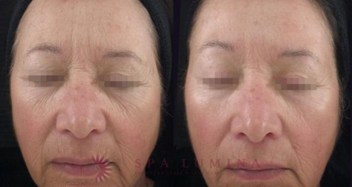 Before & After Secret RF Microneedling Case 35 Front View in Barrie, Ontario