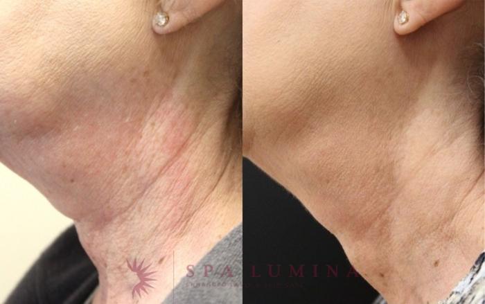 Before & After Secret RF Microneedling Case 36 Left Side View in Barrie, Ontario