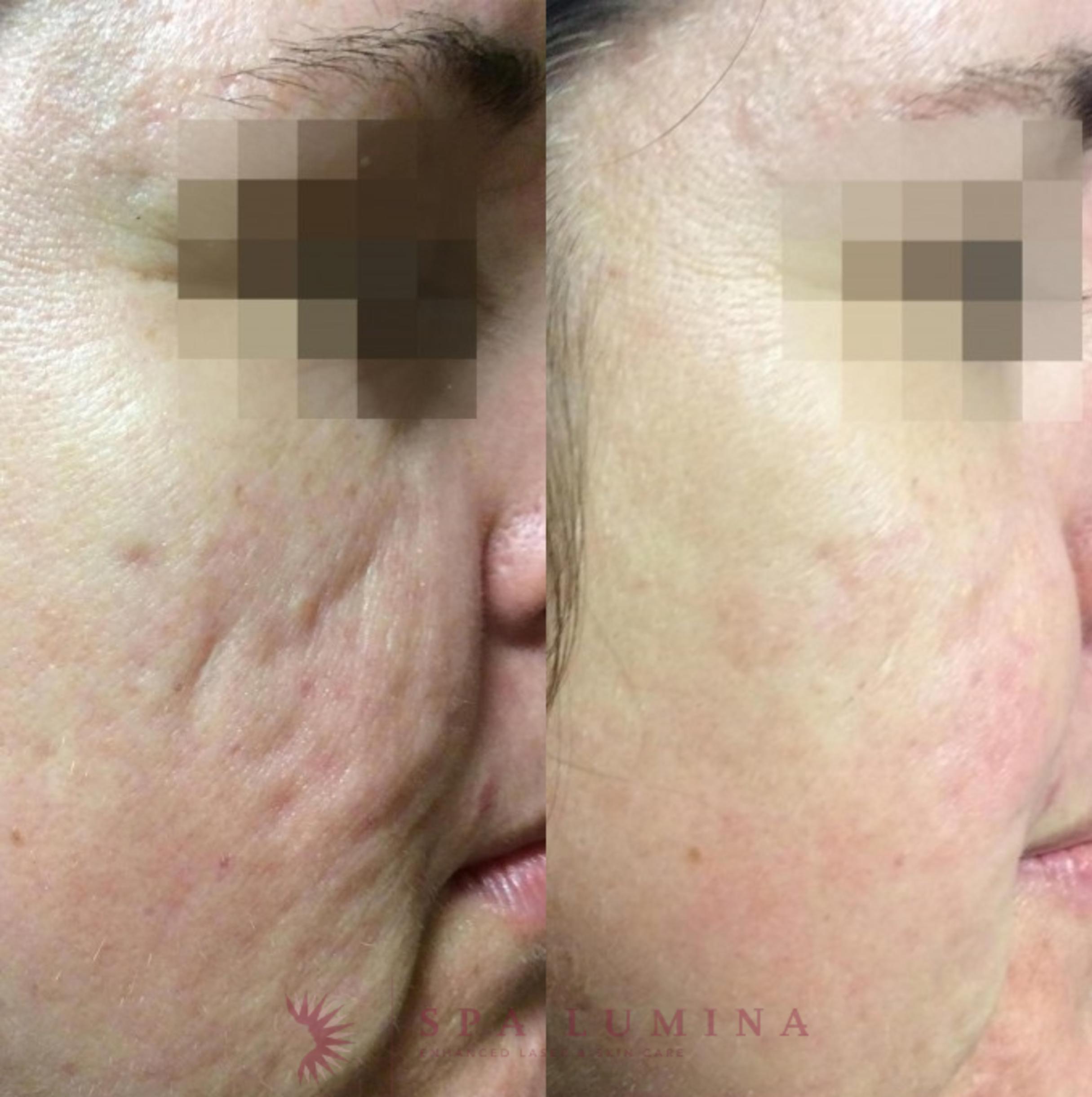 Before & After Secret RF Microneedling Case 37 Front View in Barrie, Ontario