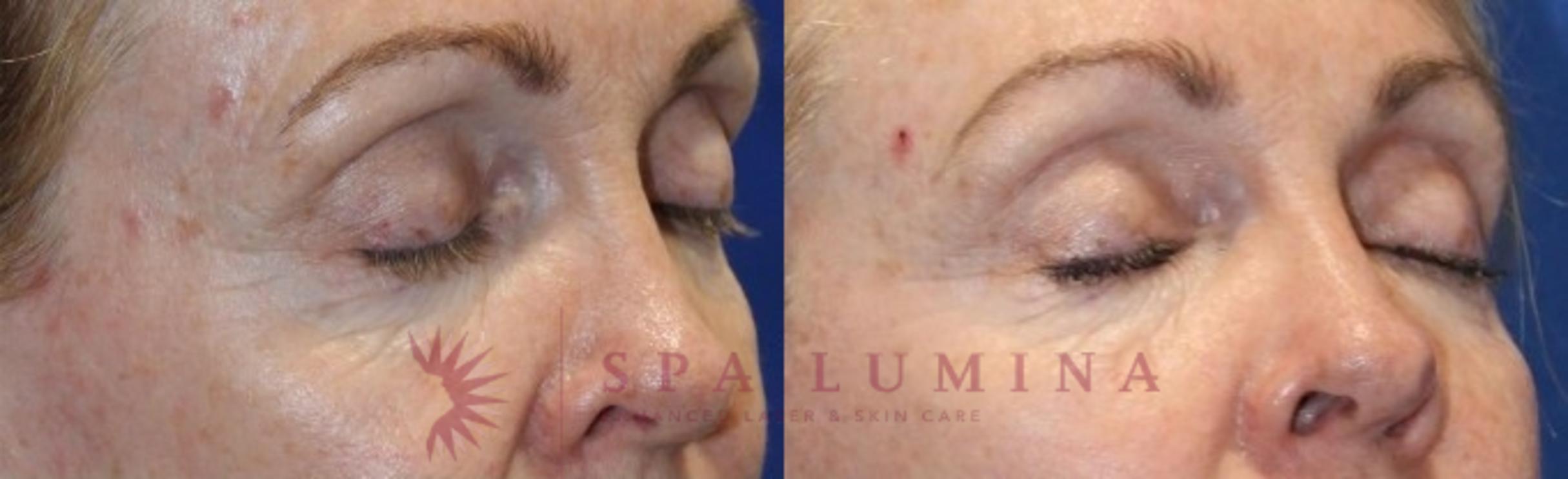 Before & After Secret RF Microneedling Case 40 Right Oblique View in Barrie, Ontario