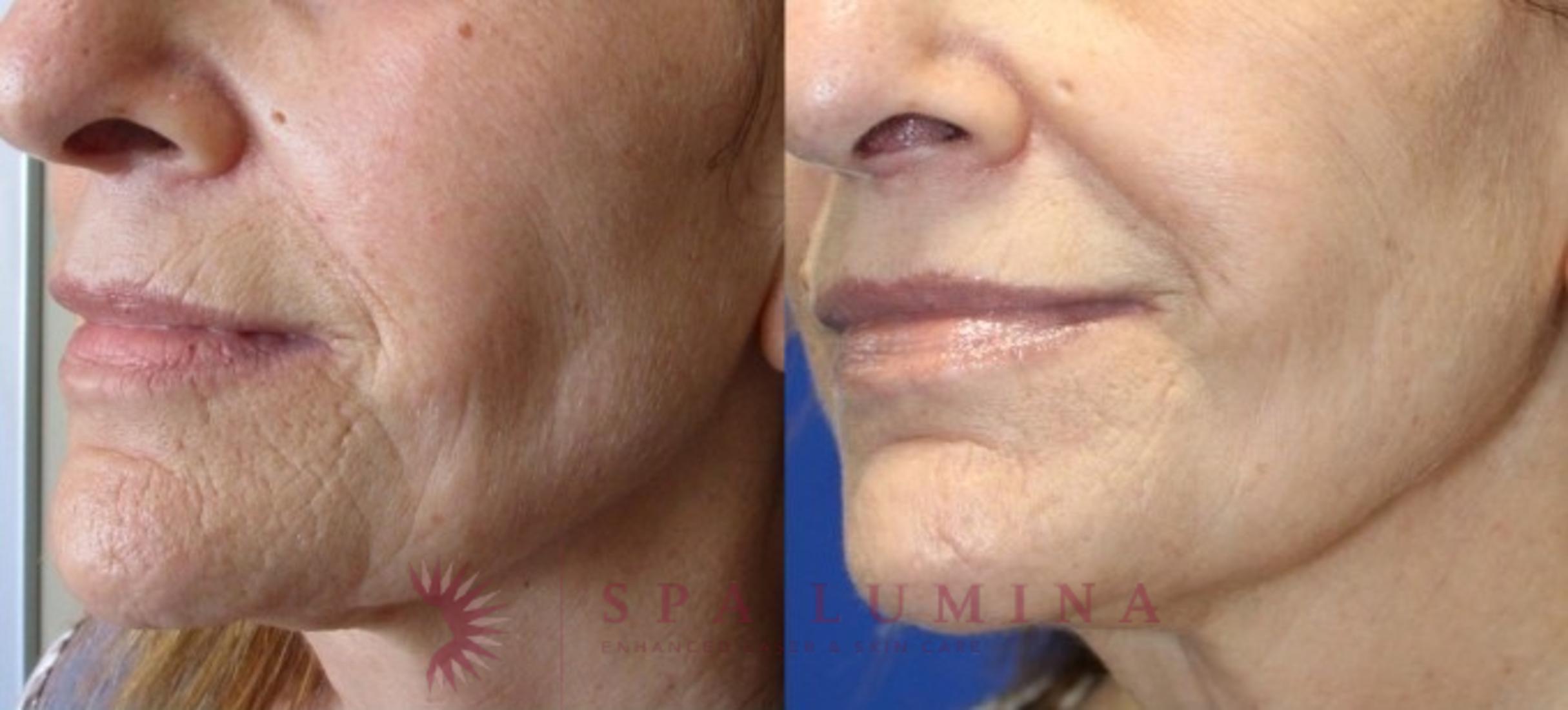 Before & After Secret RF Microneedling Case 42 Left Oblique View in Barrie, Ontario