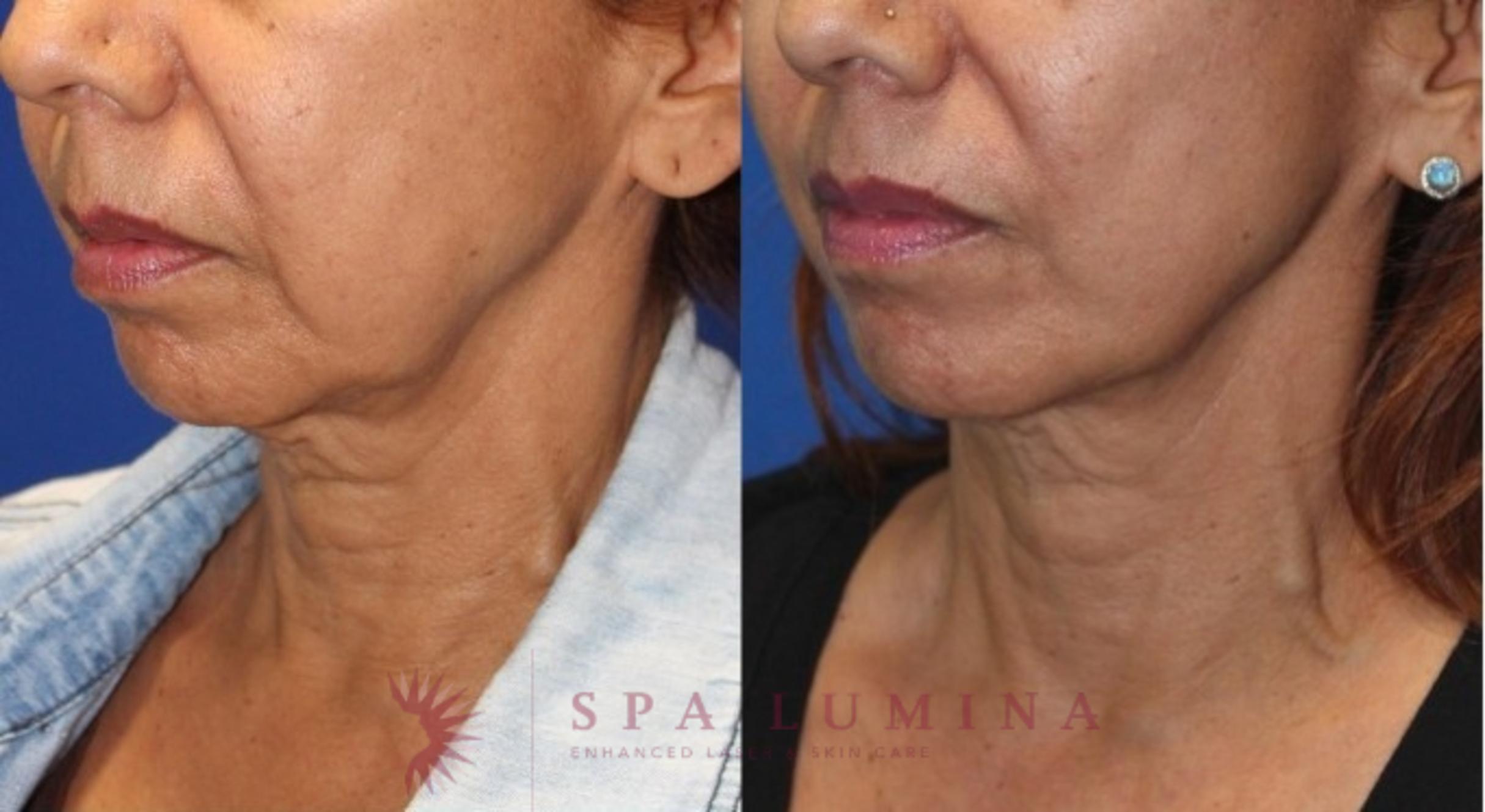 Before & After Secret RF Microneedling Case 43 Left Oblique View in Barrie, Ontario