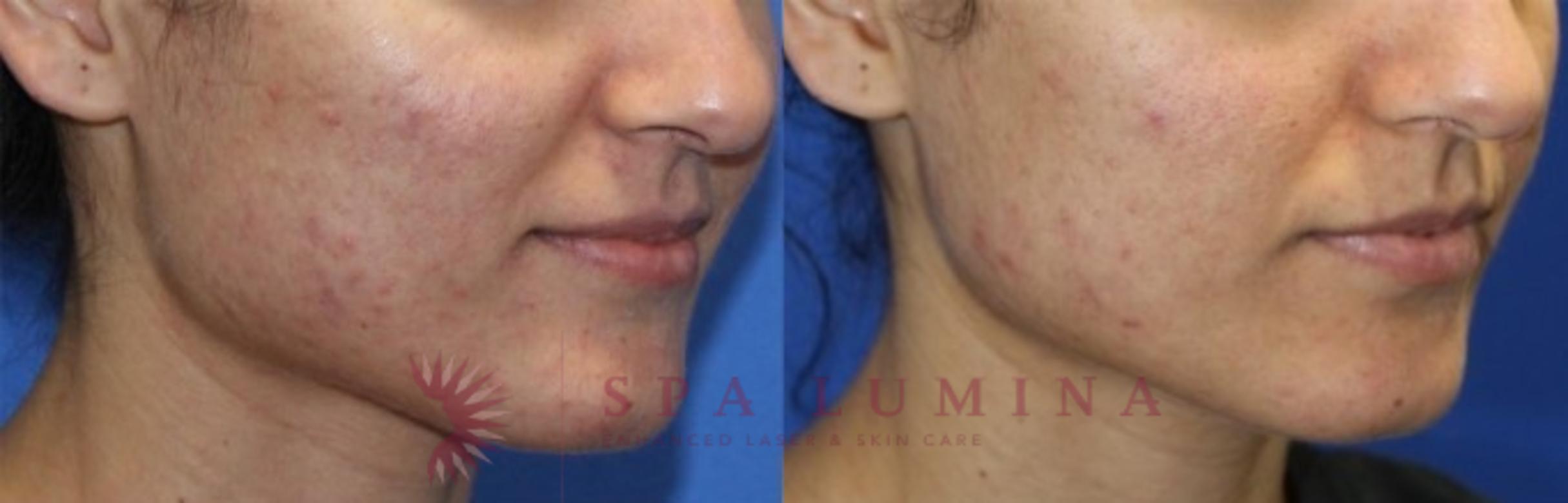 Before & After Secret RF Microneedling Case 44 Right Oblique View in Barrie, Ontario