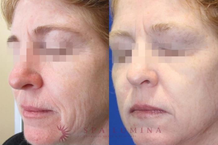 Before & After Secret RF Microneedling Case 45 Left Oblique View in Barrie, Ontario