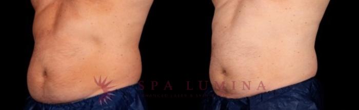 Before & After truSculpt iD Case 15 Left Oblique View in Barrie, Ontario