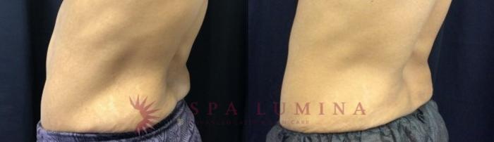 Before & After truSculpt iD Case 18 Left Side View in Barrie, Ontario