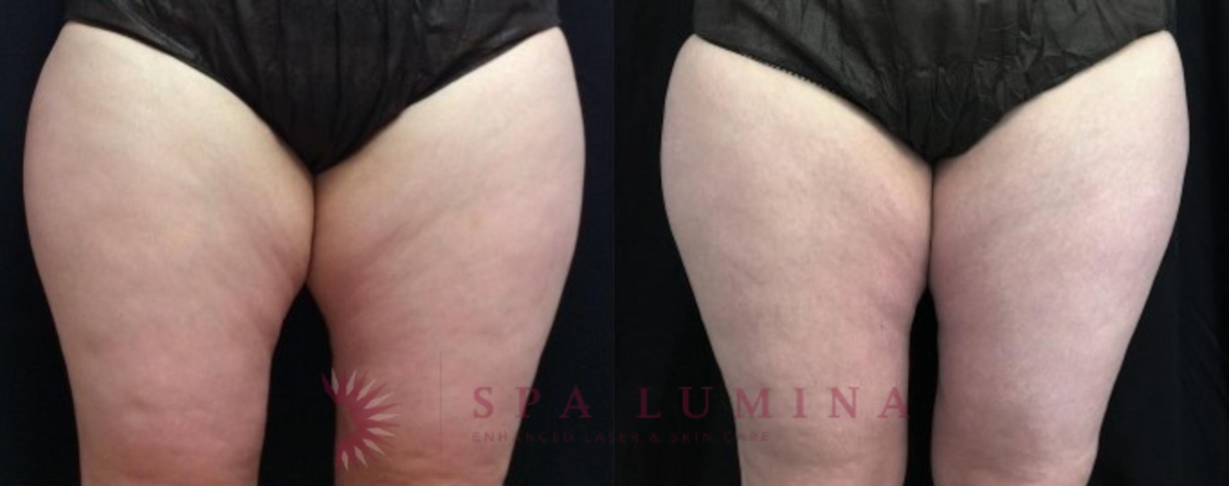 Before & After truSculpt iD Case 19 Front View in Barrie, Ontario