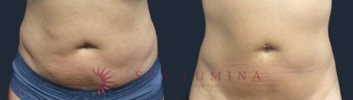 Before & After truSculpt iD Case 20 Front View in Barrie, Ontario