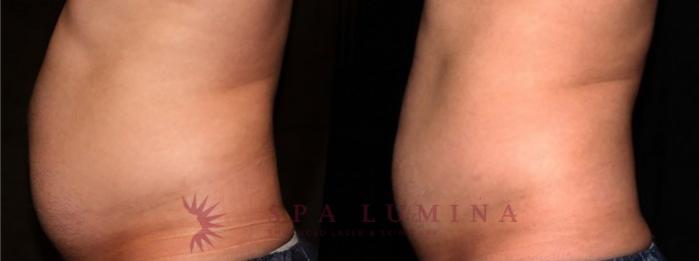 Before & After truSculpt iD Case 21 Left Side View in Barrie, Ontario