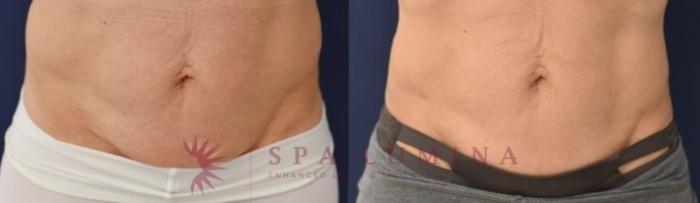 Before & After truSculpt iD Case 22 Front View in Barrie, Ontario