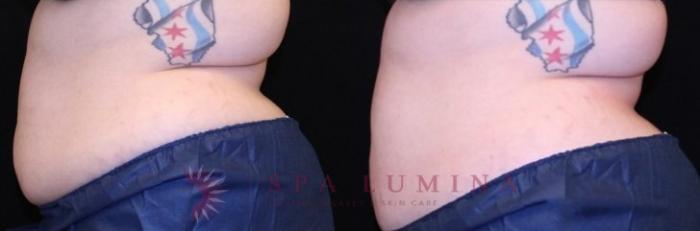 Before & After truSculpt iD Case 23 Left Side View in Barrie, Ontario