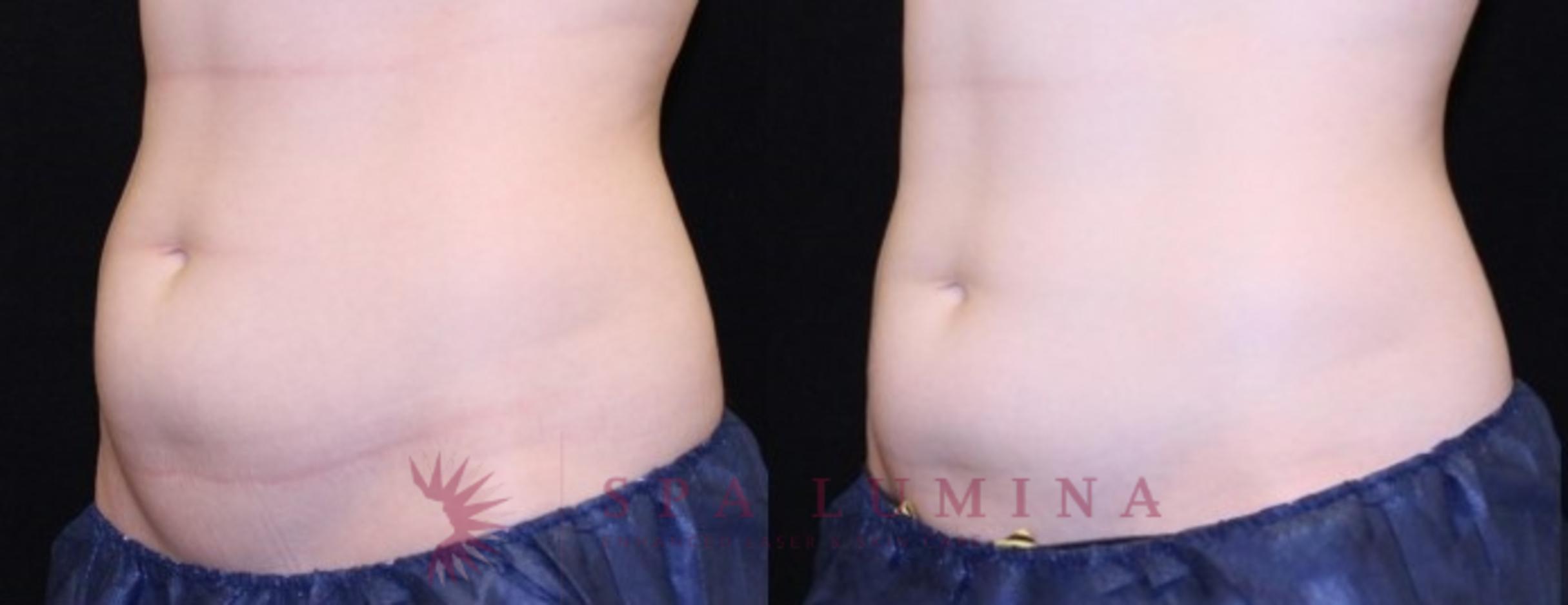 Before & After truSculpt iD Case 25 Left Oblique View in Barrie, Ontario