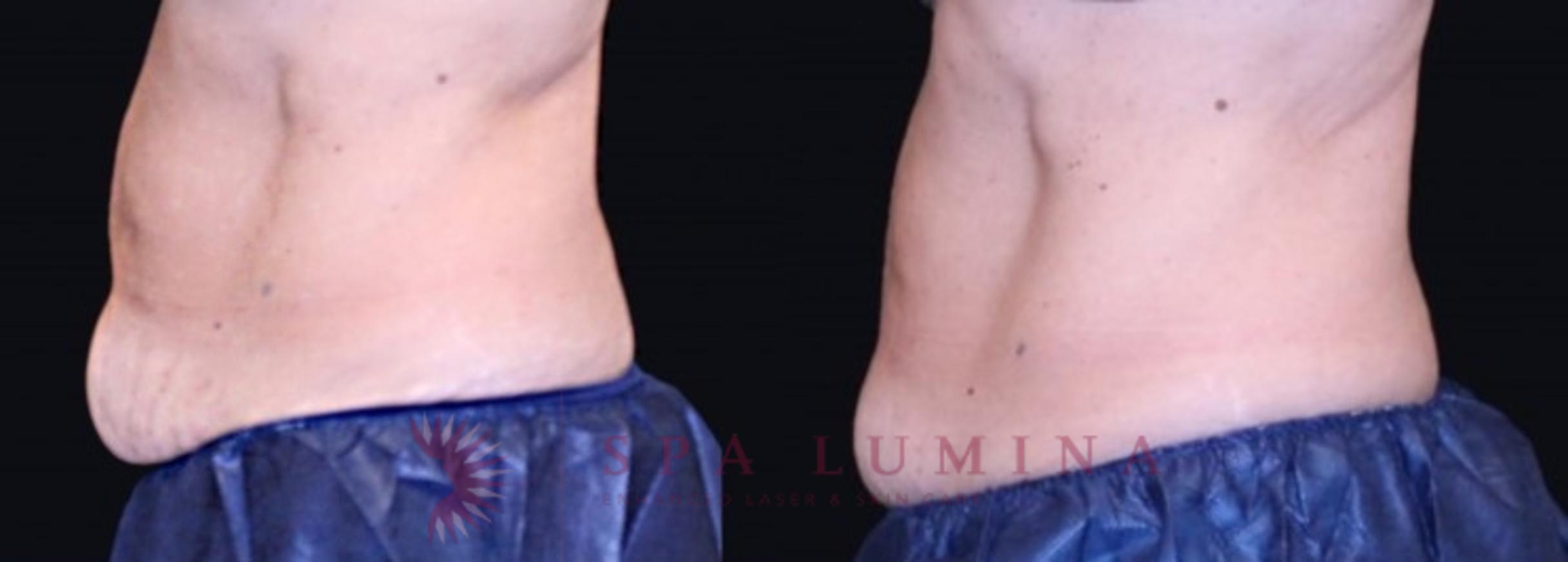 Before & After truSculpt iD Case 26 Left Side View in Barrie, Ontario